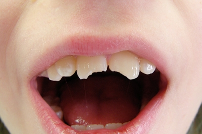 Ha­ben Sie ak­tu­ell ei­nen Un­fall mit Zahn­be­tei­li­gung er­lit­ten?